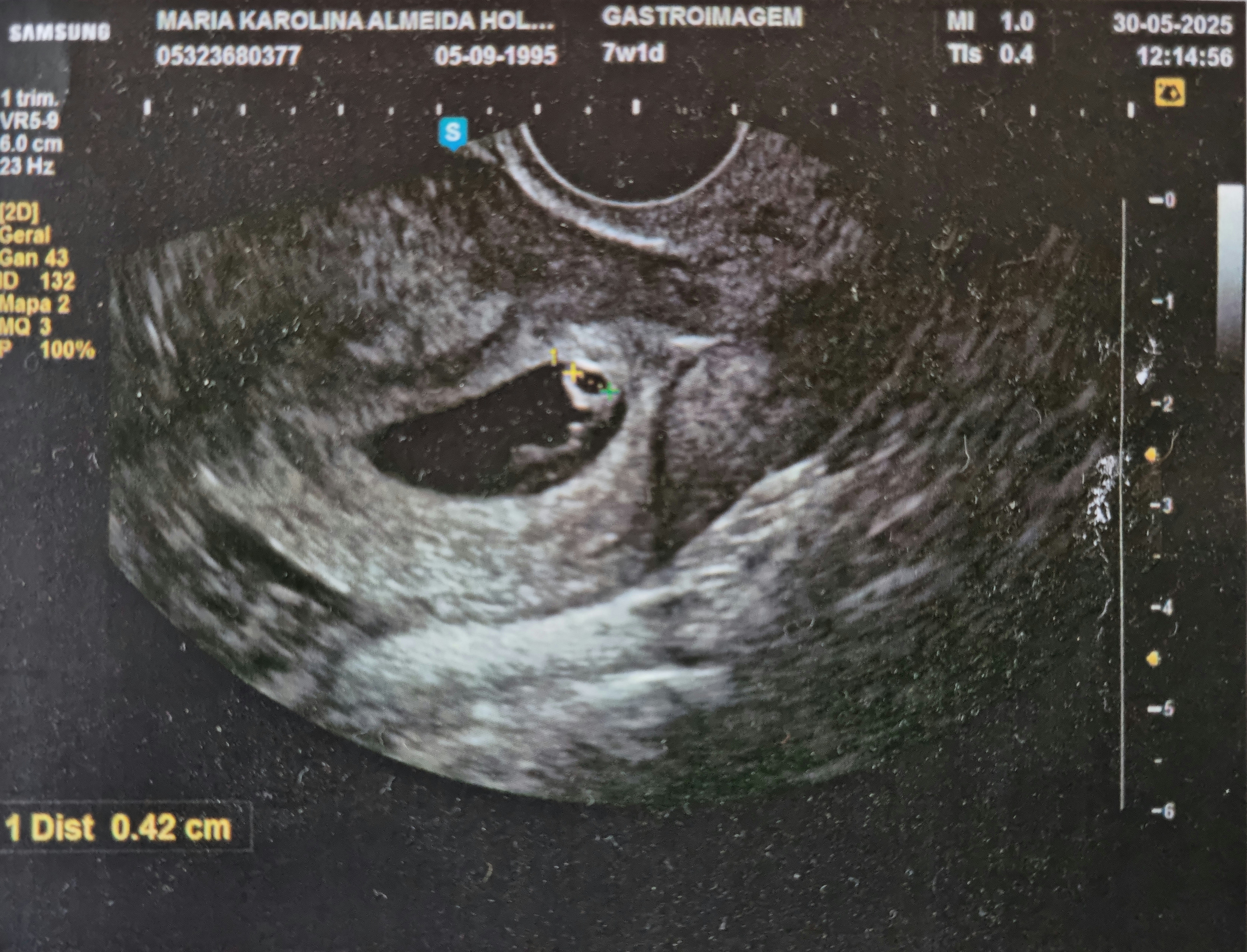 Primeira ultrassom do bebê